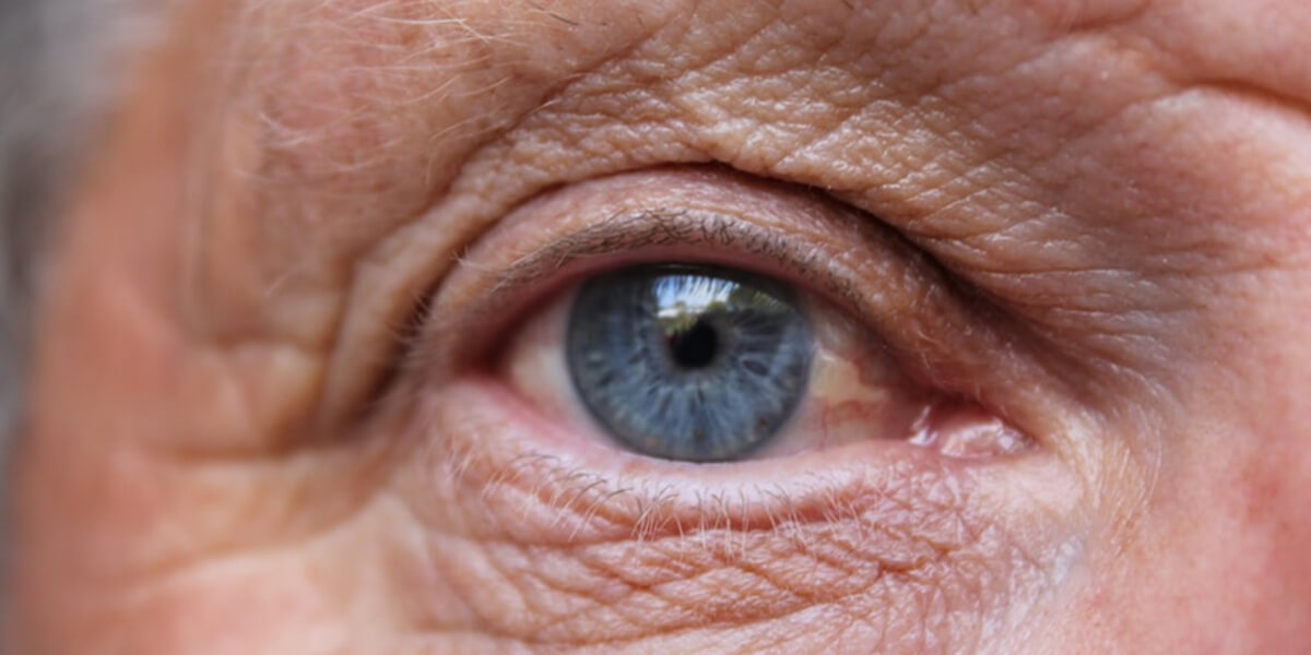 No external visual signs on the eye.