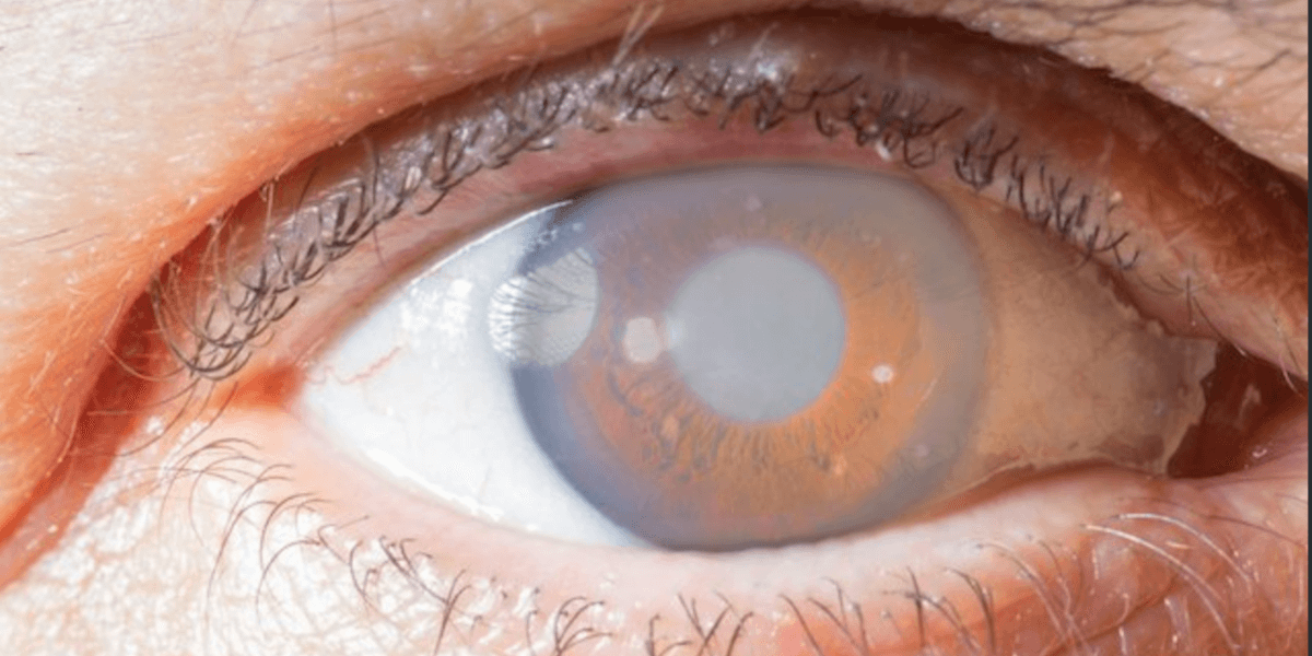 Fluid builds up in the eye, causing bludging